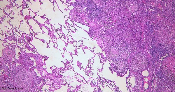Tuberculosis is a respiratory infection that can severely affect lung tissue.