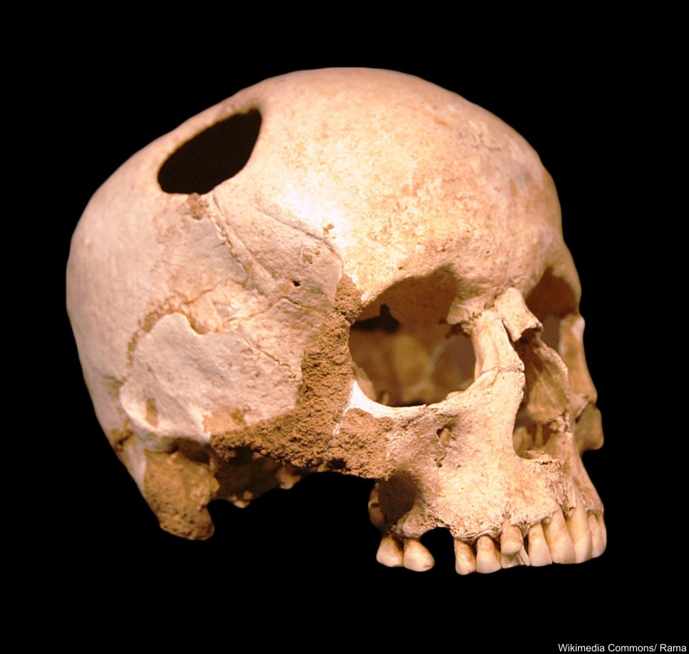French Neolithic Trapanned Skull Example