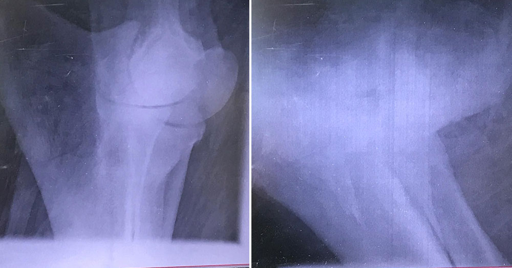 Source: Lek Chailert Poon Mee's normal leg bone (left), and broken leg bone (right).