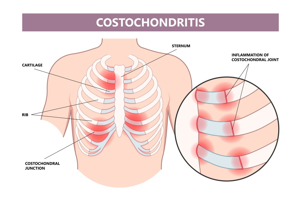 Costochondritis The Breast Cancer Treatment Side Effect You've Never Heard Of The Breast